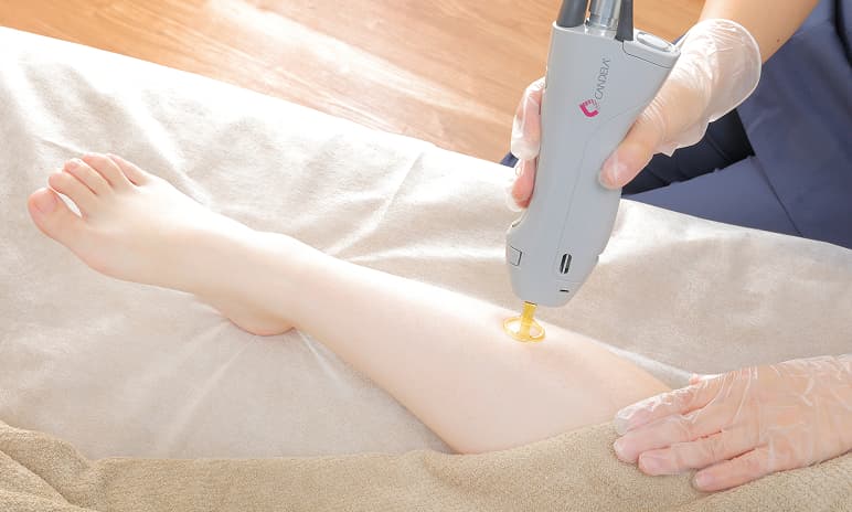 ジェントルシリーズを使用した脱毛施術