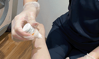 レーザー照射後にお薬を塗布します