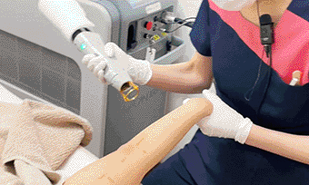 ジェントルシリーズを使用した脱毛施術