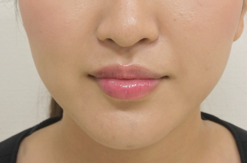 唇のヒアルロン酸注射（20代｜女性）6ヶ月後