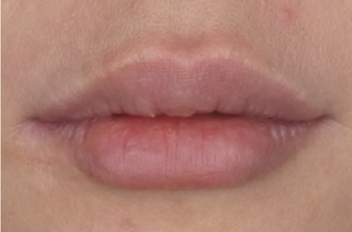 唇のヒアルロン酸注射（40代｜女性）2週間後