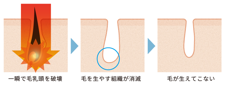 熱破壊式(ショット式)式レーザーの仕組み