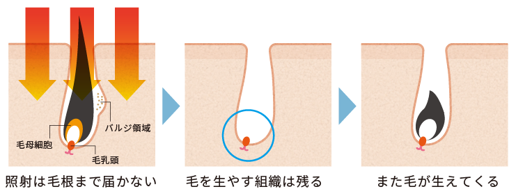 蓄熱式レーザーの仕組み