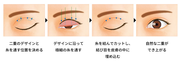 埋没法の手術の方法