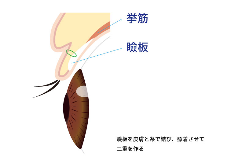 瞼板法