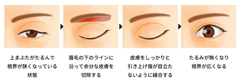 眉下切開法の手術の方法