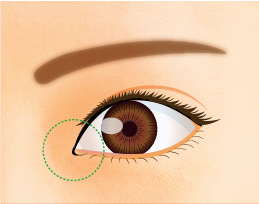 目頭切開法 目頭切開法なら全国12院展開のルシアクリニック