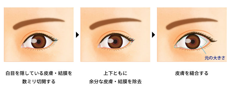 目尻切開法の手術の方法