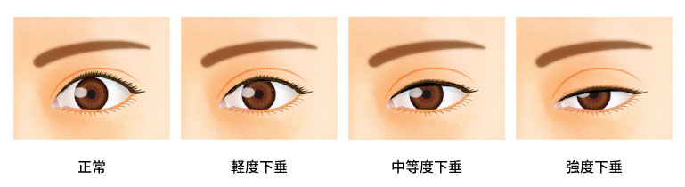 眼瞼下垂の進行度