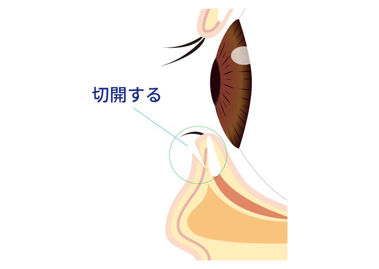 下瞼皮膚切除