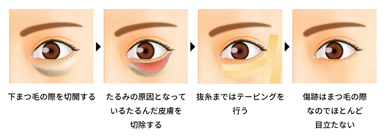 皮膚側切開