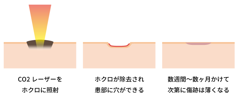 ホクロ除去の過程