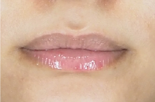 唇のヒアルロン酸注射（30代｜女性）