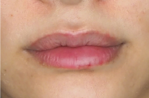 唇のヒアルロン酸注射（30代｜女性）直後