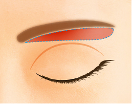 眉毛の下のラインに沿って余分な皮膚を切除する