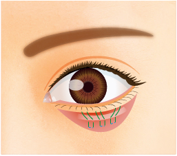 瞼板と筋膜に糸を通しラインを調整して固定する