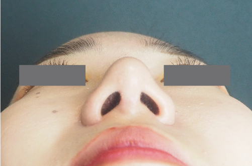 整鼻術（10代｜女性）1ヶ月後