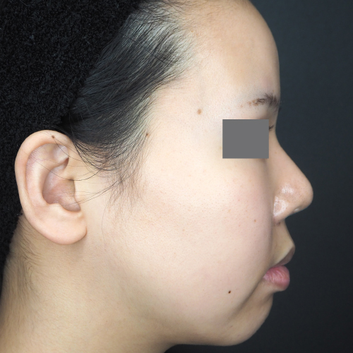 整鼻術（20代｜女性）3ヶ月後