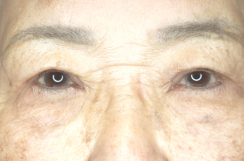 眼瞼下垂（50代以上｜女性）3ヶ月後