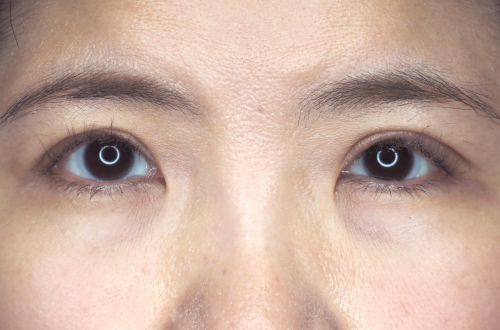眼瞼下垂（40代｜女性）3ヶ月後