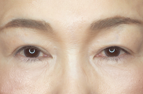 眼瞼下垂（50代以上｜女性）3ヶ月後