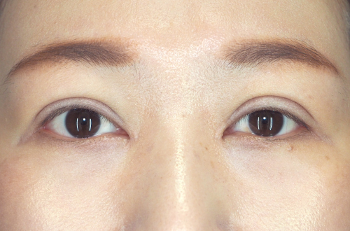 眼瞼下垂（30代｜女性）3ヶ月後