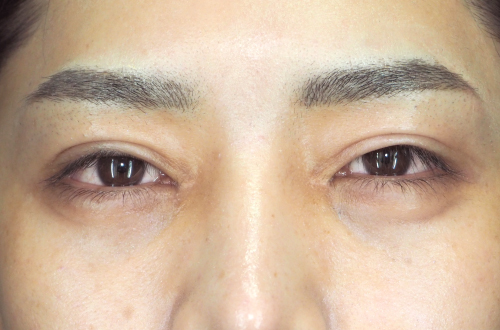 眼瞼下垂（20代｜男性）3ヶ月後