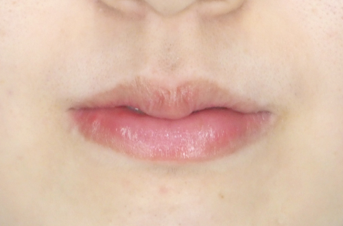 口唇縮小術（20代｜女性）3ヶ月後