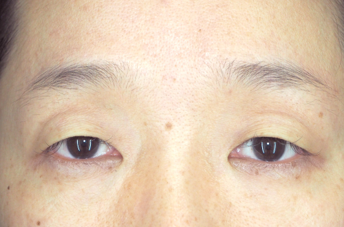 眼瞼下垂（40代｜女性）