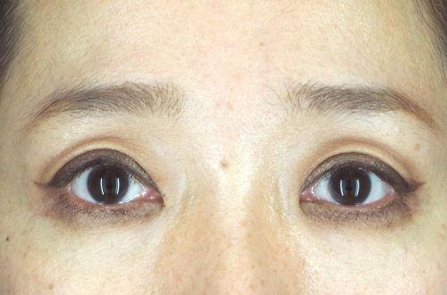 眼瞼下垂（40代｜女性）3ヶ月後