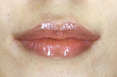 唇のヒアルロン酸注射（30代｜女性）2週間後