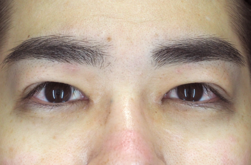 眼瞼下垂（30代｜男性）3ヶ月後