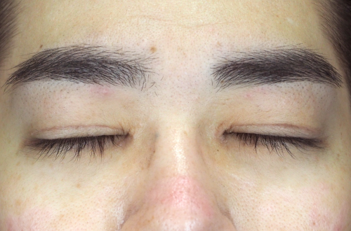眼瞼下垂（30代｜男性）3ヶ月後
