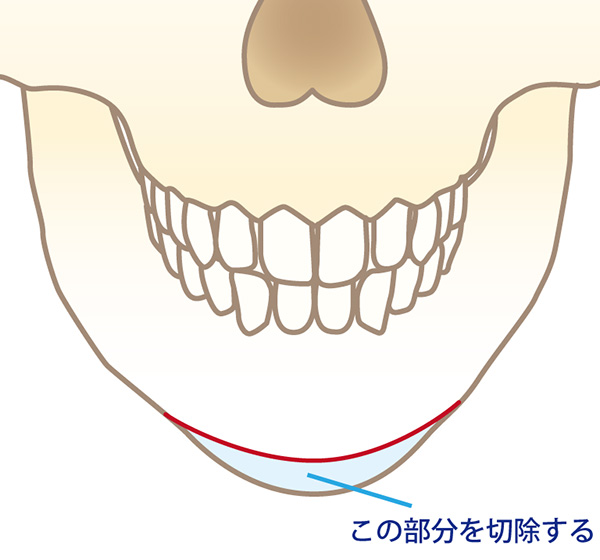 アゴ先の骨を切除する