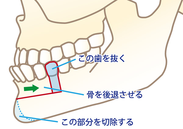 下顎4番の歯を抜き、下の前歯6本を骨ごと切り、必要な分だけ骨を引き抜き後ろに下げる