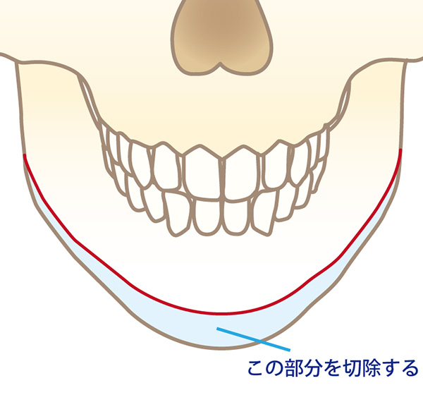 アゴ周りの骨を切除する