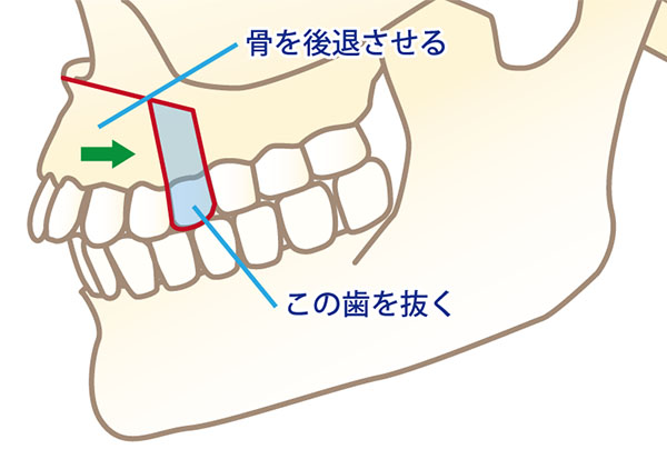 上顎4番の歯を抜き、上の前歯6本を骨ごと切り、必要な分だけ骨を引き抜き後ろに下げる