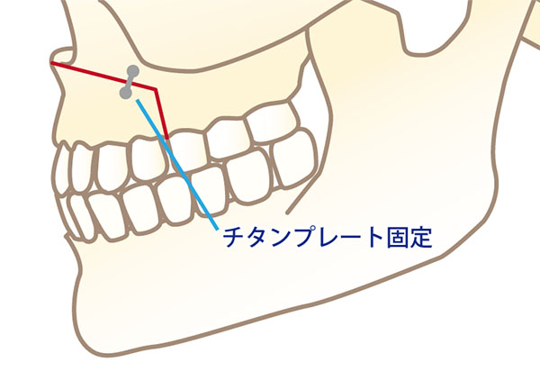 後退させた骨はチタンプレートで固定する