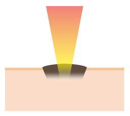 CO2レーザーを照射