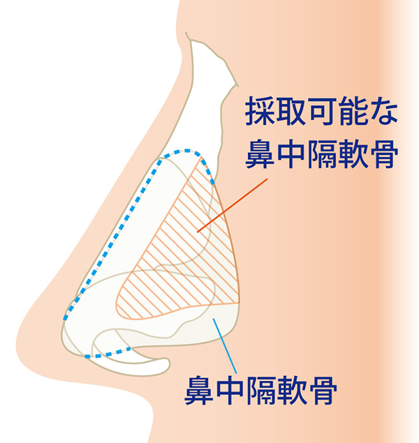 鼻中隔軟骨