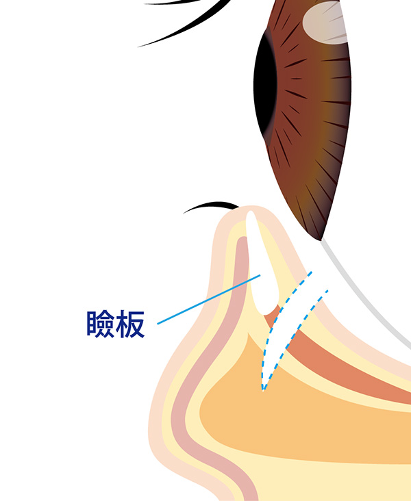 後方アプローチ法