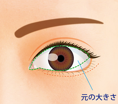 切開箇所を縫合して仕上げる