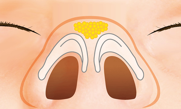 鼻先の余分な脂肪を除去する