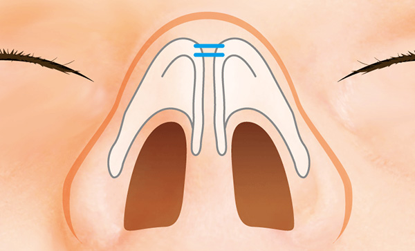 大鼻翼軟骨を縫い寄せて鼻先を整える