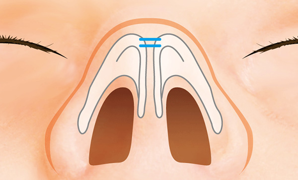 横に広がった大鼻翼軟骨を縫い寄せても高さが足りない