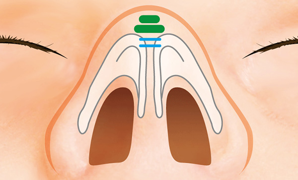 採取して形を整えた軟骨をピラミッド状に移植し、鼻先を整える