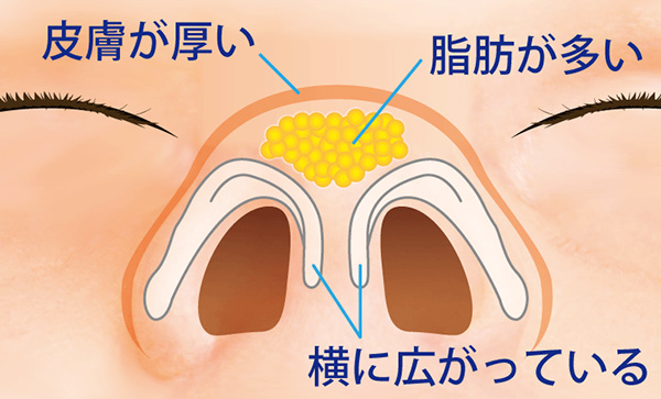 団子鼻のイメージ図