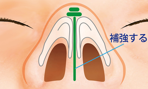 大鼻翼軟骨の補強として、耳介軟骨を大鼻翼軟骨の内側脚に移植する