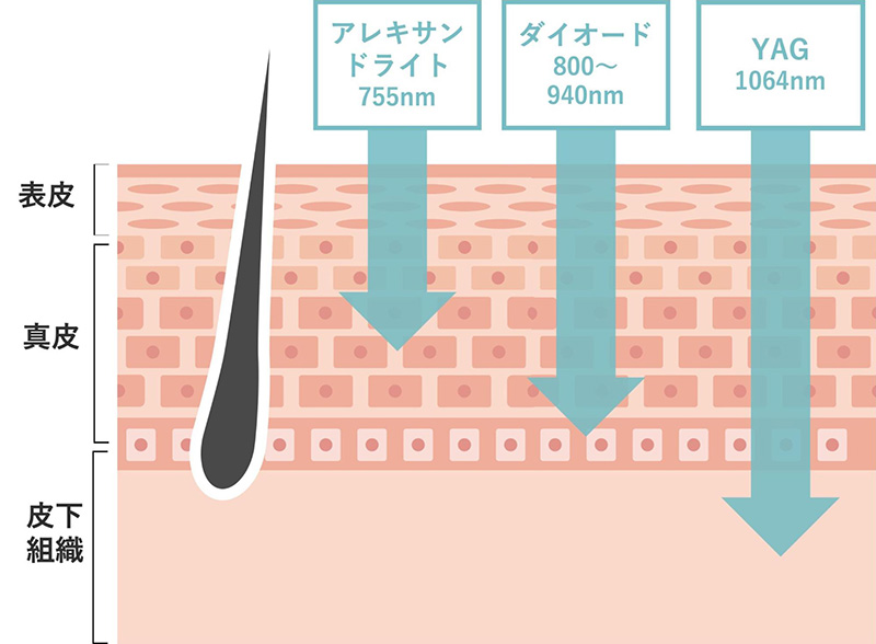 レーザーが照射できる範囲の比較