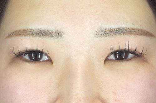 目頭切開法（20代｜女性）